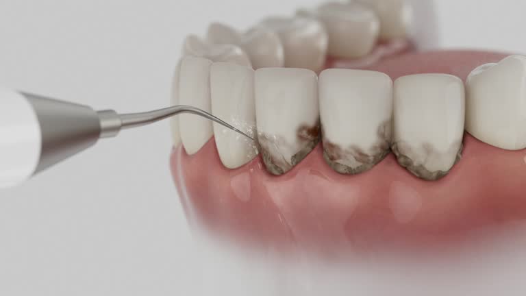 Trusted Wisdom Tooth Removal service in Quincy, IL - Dentist Open Now